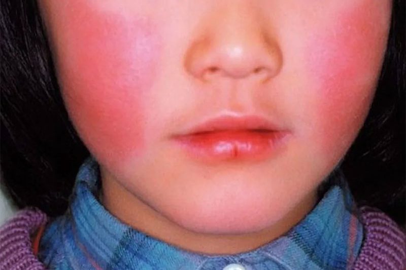 Japan’s “Apple Disease” Outbreak Hits Fever Pitch: A Rash of Worry for Families